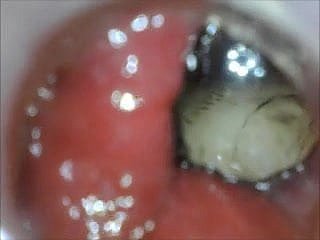 anal endoscope irritant play from inner